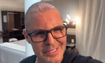 Apos procedimento Eduardo Costa aparece careca em show