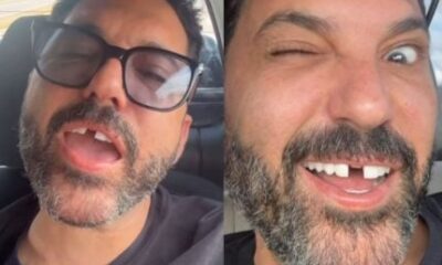 Edson perde dente antes de show e Hudson nao perdoa