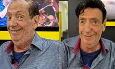 Marcos Oliveira o eterno Beicola passa por procedimento e aparece