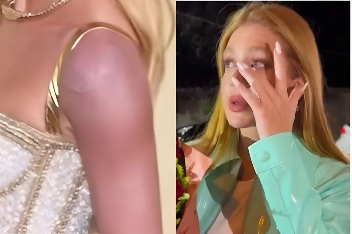 Marina Ruy Barbosa aparece com braco roxo e se justifica