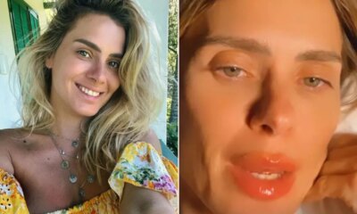 Novo procedimento Carolina Dieckmann aparece com labios inchados e medico