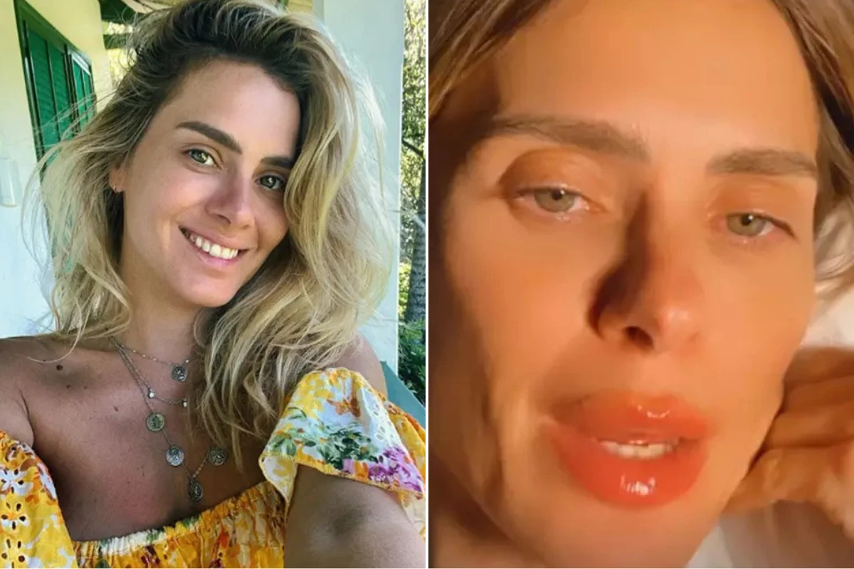 Novo procedimento? Carolina Dieckmann aparece com lábios inchados e médico faz alerta 31 Novo procedimento Carolina Dieckmann aparece com labios inchados e medico