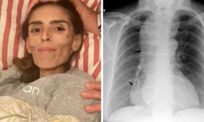 sintomas tratamento e causas da doenca rara que tirou a