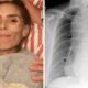 sintomas tratamento e causas da doenca rara que tirou a