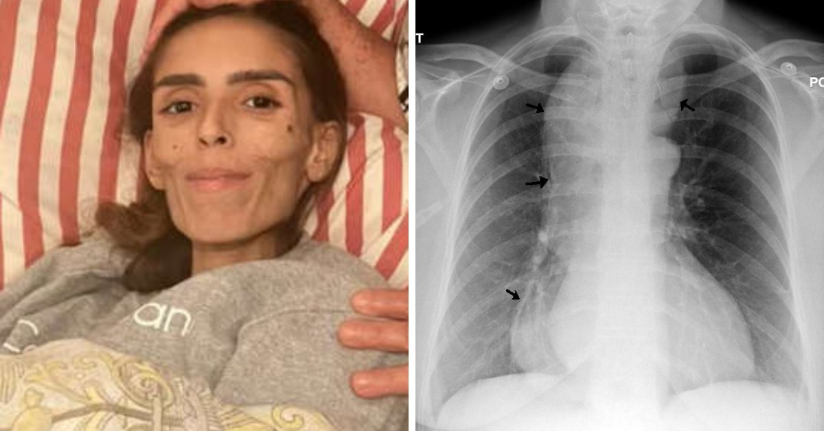 sintomas, tratamento e causas da doença rara que tirou a vida de jovem de 22 anos que pesava 27kg em MG 31 sintomas tratamento e causas da doenca rara que tirou a