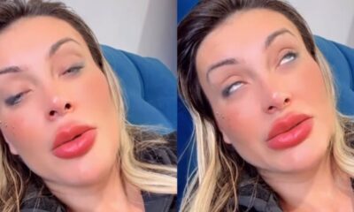 Andressa Urach relata piora e complicacao apos cirurgia estetica nos
