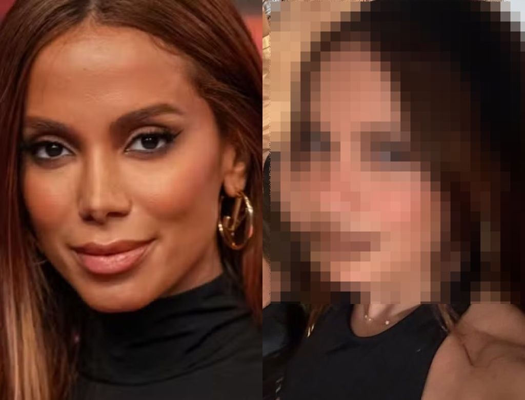 Anitta reaparece 1ª vez após procedimento estético e web se assusta; veja! 37 Anitta 136(1)