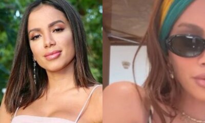 Anitta surge com rosto irreconhecivel apos periodo de recuperacao