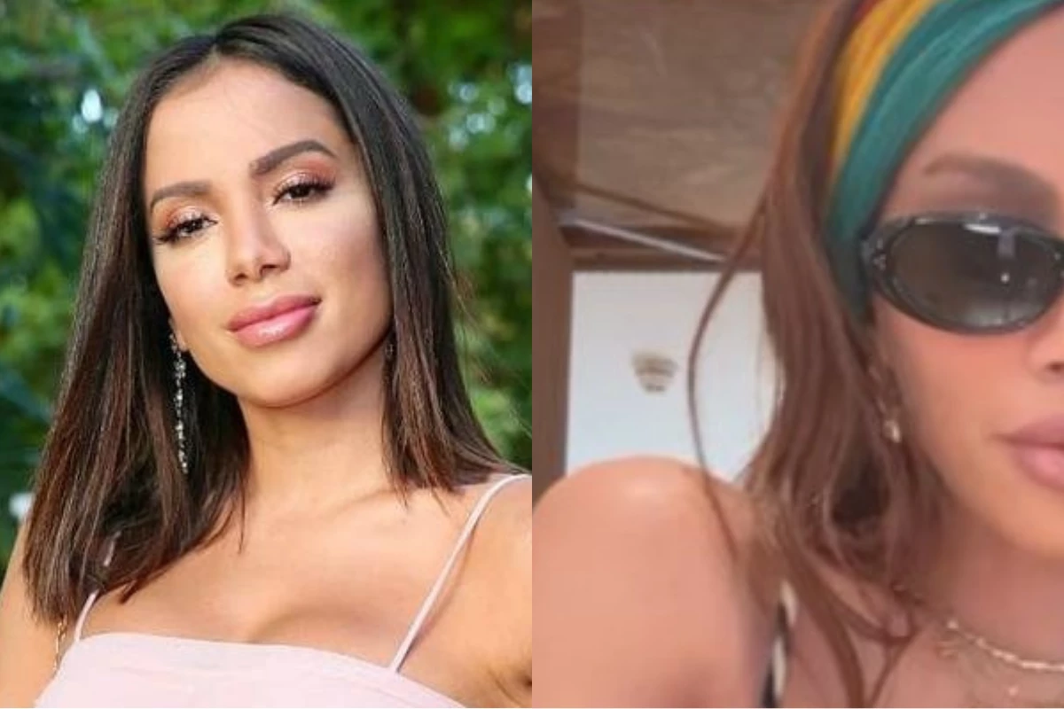 Anitta surge com rosto irreconhecível após período de recuperação 33 Anitta surge com rosto irreconhecivel apos periodo de recuperacao