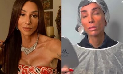 Ceratopigmentacao estetica o procedimento feito por Maya Massafera e os