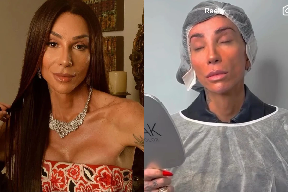 Ceratopigmentação estética: o procedimento feito por Maya Massafera e os alertas de oftalmologistas 35 Ceratopigmentacao estetica o procedimento feito por Maya Massafera e os