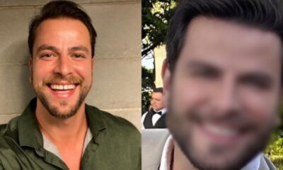 Ex BBB Gustavo Marsengo mostra resultado de harmonizacao facial e web