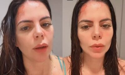 Gravida ex Casamento as Cegas sofre grave acidente e exibe queimaduras