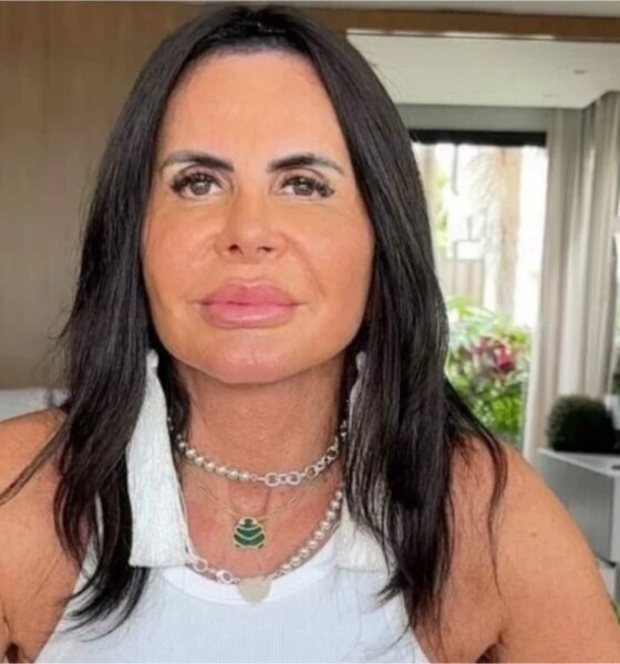 Gretchen passa por nova harmonizacao e exibe resultado real nas