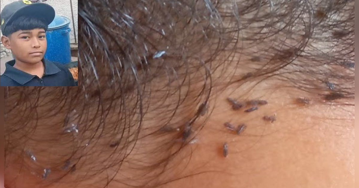 Identificado garoto de 12 anos que morreu vítima de infecção grave provocada por infestação de piolhos; caso serve de alerta 31 Identificado garoto de 12 anos que morreu vitima de infeccao