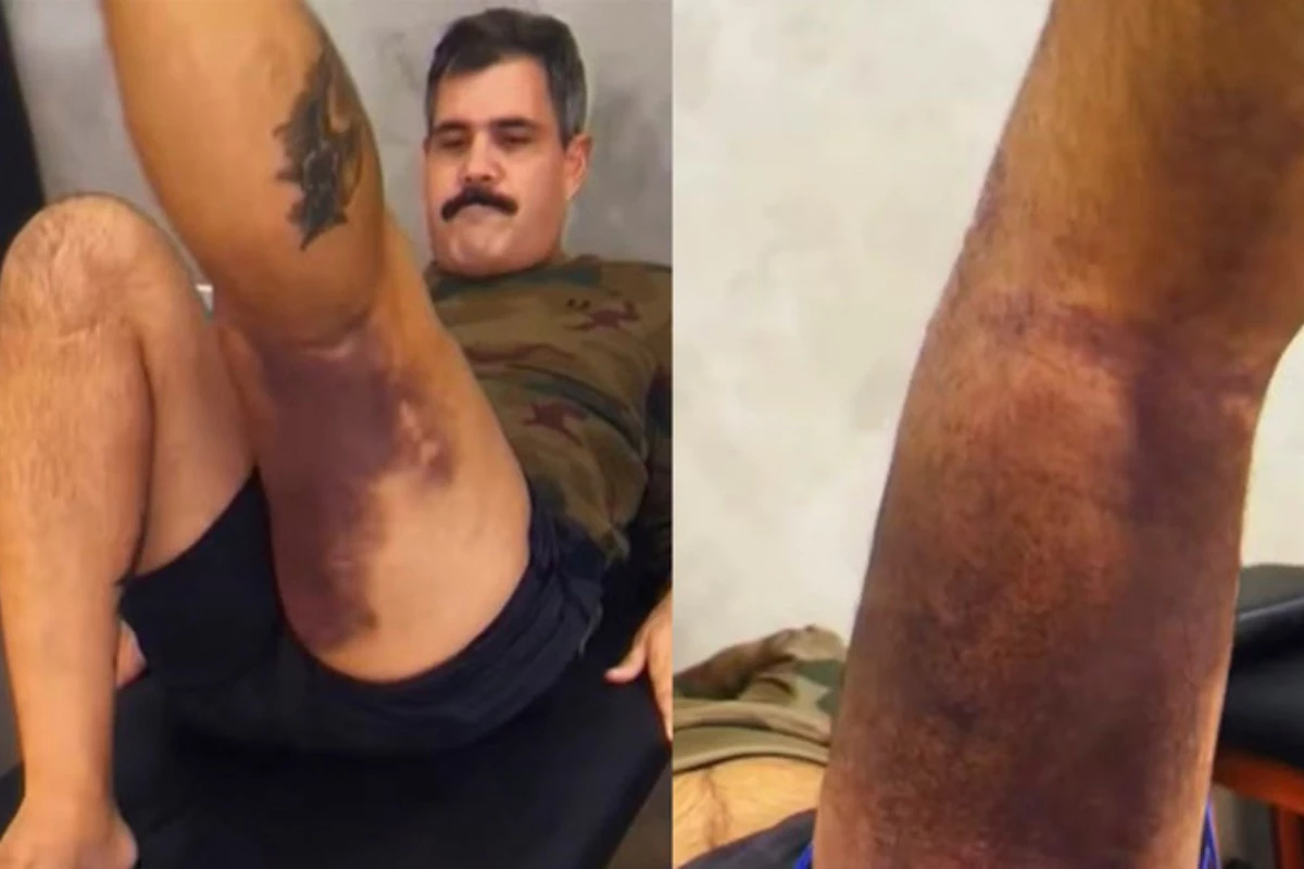 Juliano Cazarré inicia reabilitação após cirurgia no joelho e queda que reabriu pontos; vídeo mostra otimismo 31 Juliano Cazarre inicia reabilitacao apos cirurgia no joelho e queda