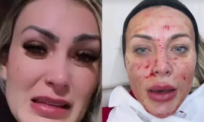Andressa Urach volta a assustar seguidores ao surgir com o