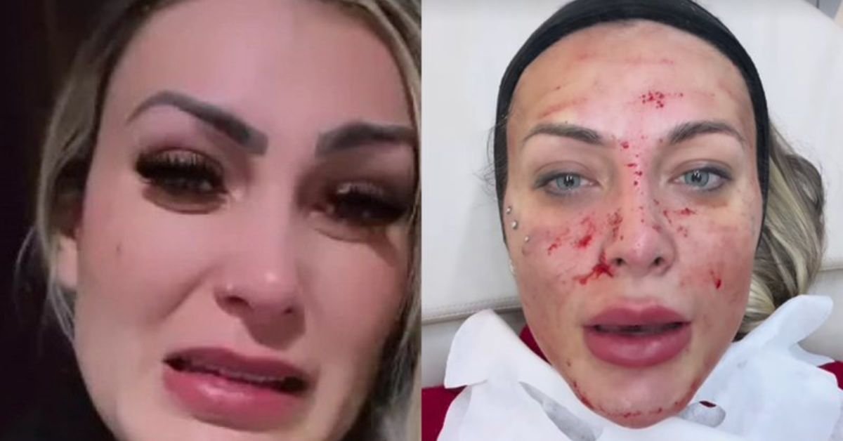 Andressa Urach volta a assustar seguidores ao surgir com o