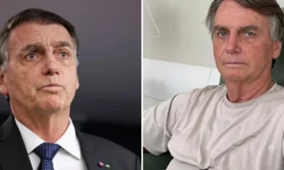 Bolsonaro passa por endoscopia e tera tratamento medico intensificado