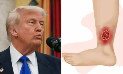 Donald Trump e diagnosticado com insuficiencia venosa cronica informa Casa