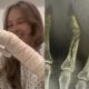 Sammy ex de Pyong Lee exibe novos registros da fratura