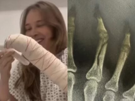 Sammy, ex de Pyong Lee, exibe novos registros da fratura na mão e impressiona 31 Sammy ex de Pyong Lee exibe novos registros da fratura