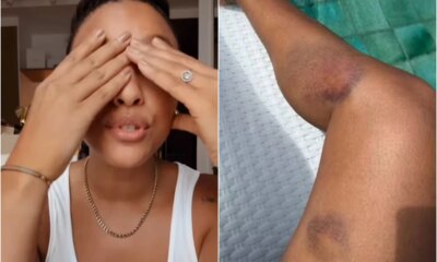 Sheron Menezzes se manifesta apos ocorrido e exibe os hematomas
