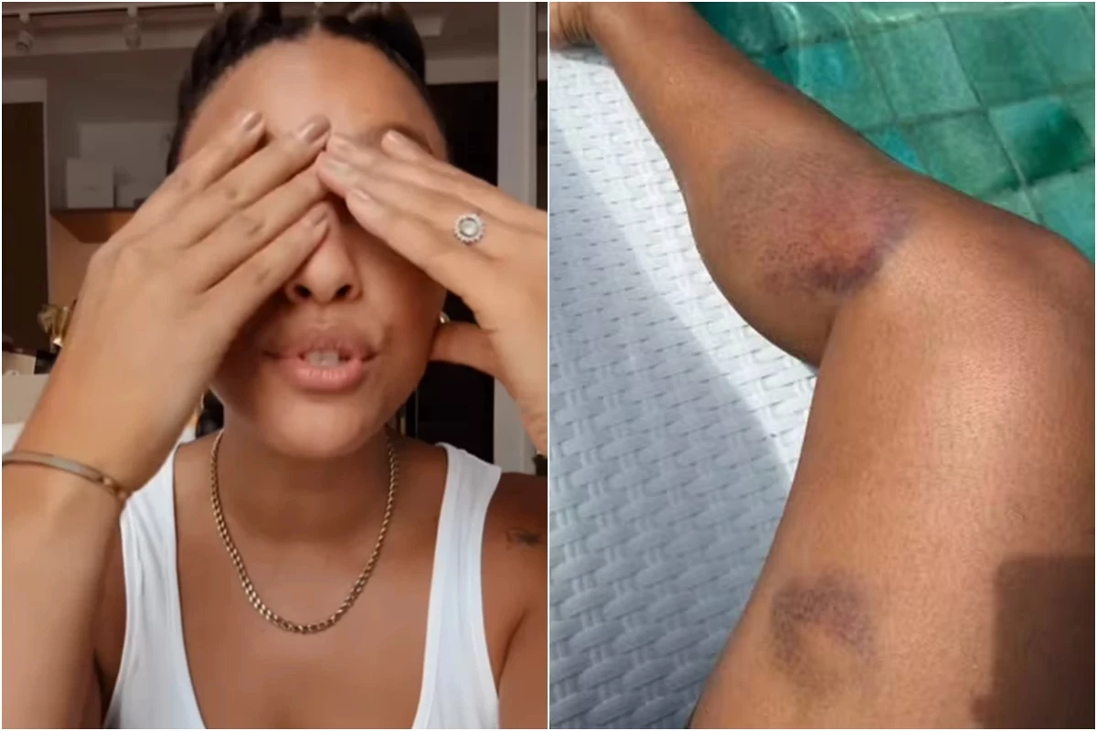 Sheron Menezzes se manifesta após ocorrido e exibe os hematomas: ‘está…’ 31 Sheron Menezzes se manifesta apos ocorrido e exibe os hematomas