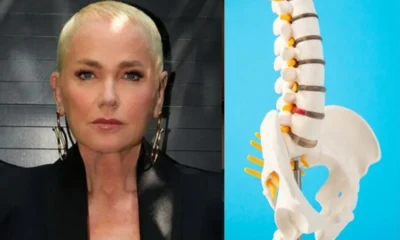Conheca a doenca que afetou Xuxa e a levou para.webp