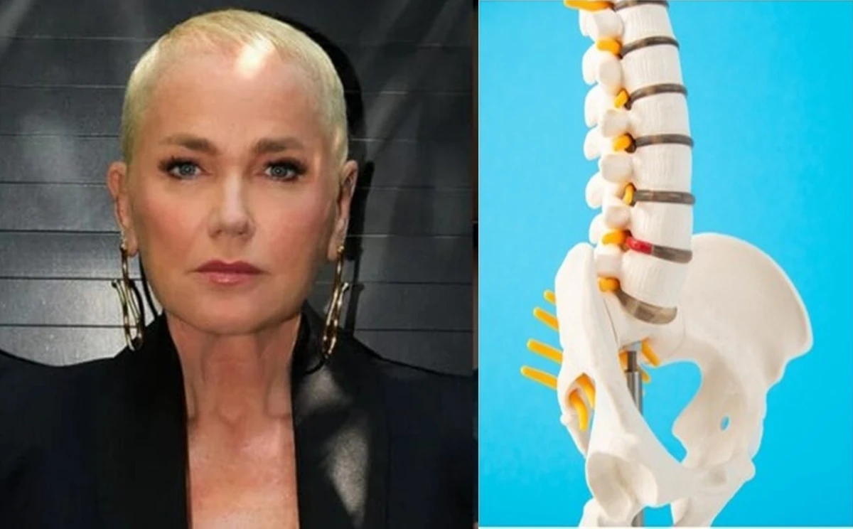 Conheca a doenca que afetou Xuxa e a levou para.webp