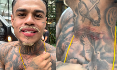 MC Cabelinho mostra pescoco machucado apos sofrer tentativa de assalto