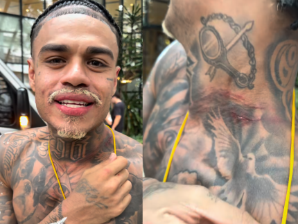 MC Cabelinho mostra pescoco machucado apos sofrer tentativa de assalto