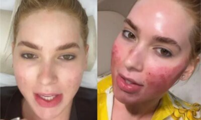 O que aconteceu com o rosto de Virginia Fonseca A