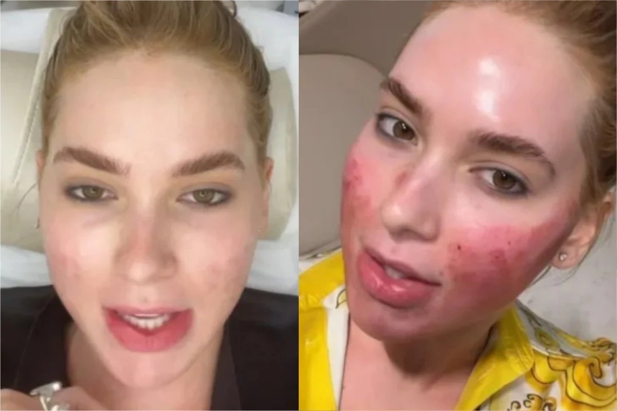 O que aconteceu com o rosto de Virginia Fonseca A