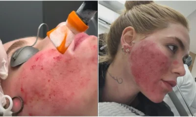 Rosto em carne viva de Virginia e normal Especialista.webp