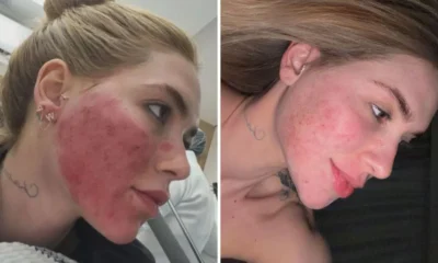 Virginia mostra rosto apos procedimento que o deixou em.webp