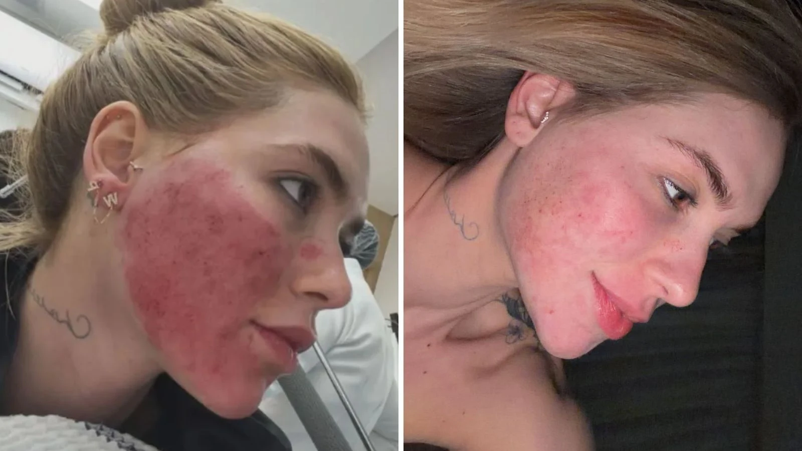 Virginia mostra rosto apos procedimento que o deixou em.webp