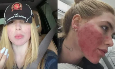 Virginia se arrepende de procedimento no rosto Tinha necessidade.webp