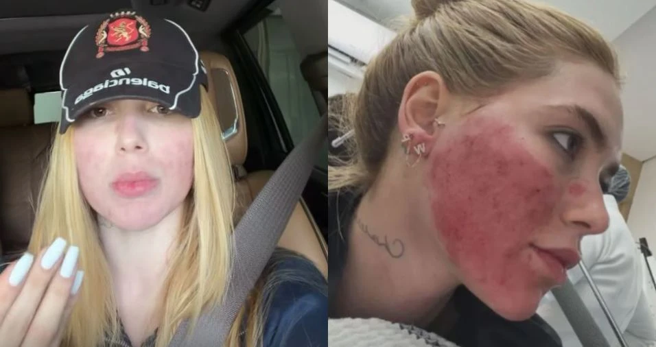 Virginia se arrepende de procedimento no rosto Tinha necessidade.webp