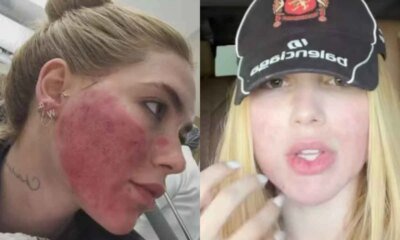 Virginia surge arrependida apos procedimento que deixou rosto em carne