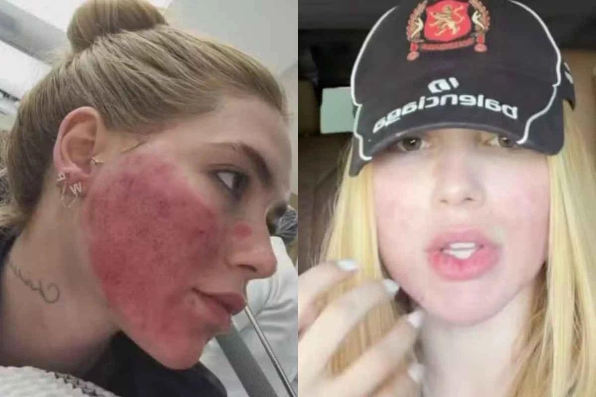 Virginia surge arrependida apos procedimento que deixou rosto em carne