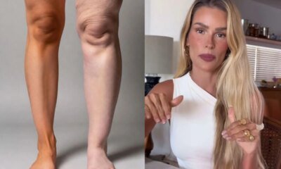 Yasmin Brunet conta sua luta contra doenca cronica e da