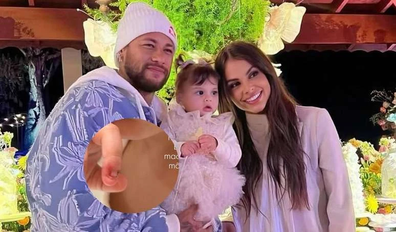 Apos fratura exposta em grave acidente Amanda Kimberlly mostra.webp