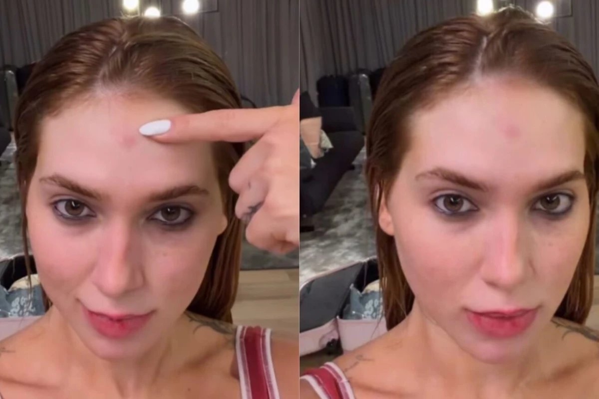 Virginia mostra hematoma apos ensaio da Grande Rio e comenta