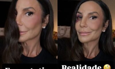 Expectativa x realidade Ivete Sangalo mostra como ficou o rosto