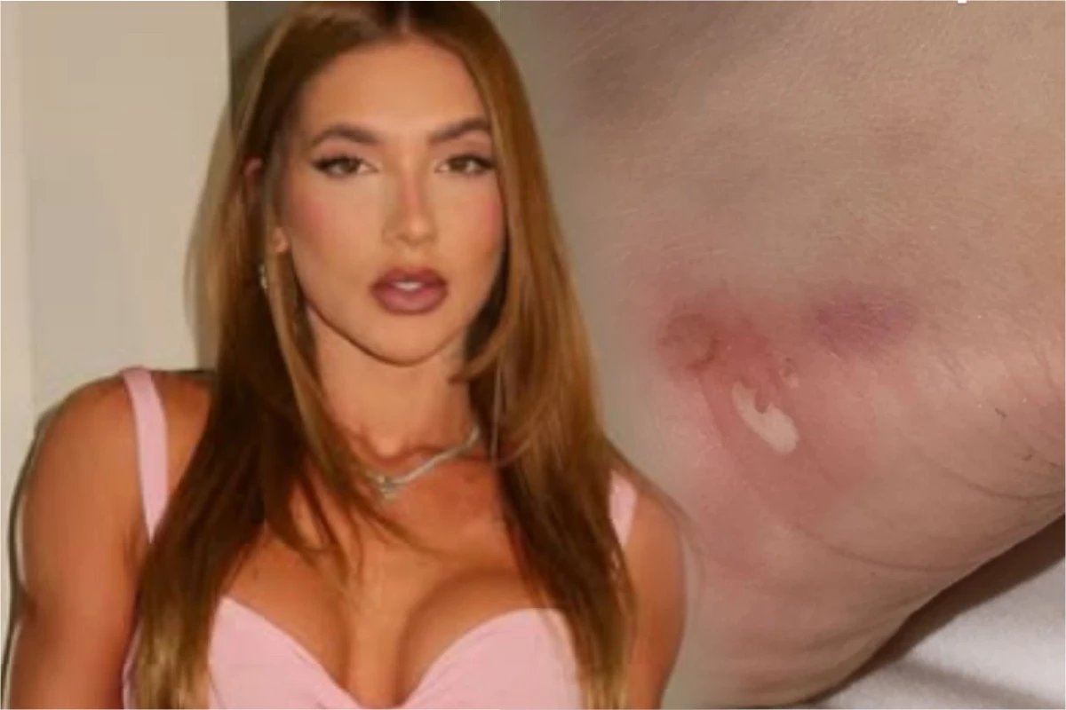 Fotos Virginia Fonseca exibe o corpo ferido nas redes sociais