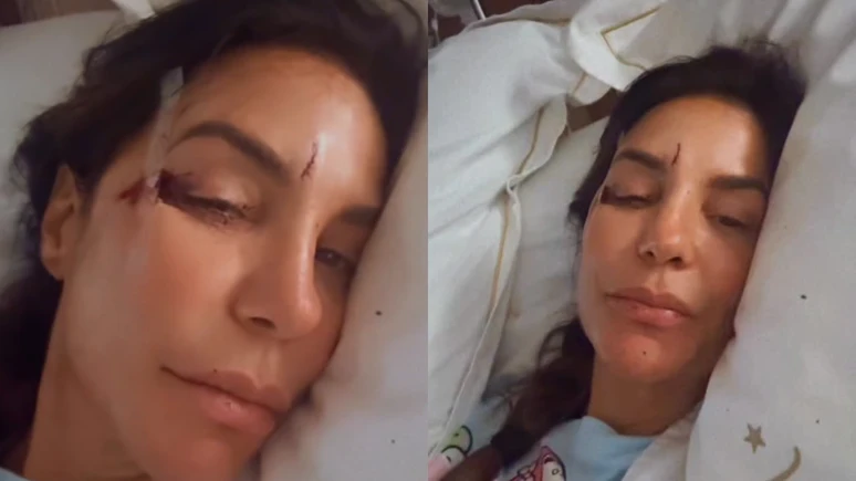 Ivete Sangalo e internada e mostra rosto machucado.webp