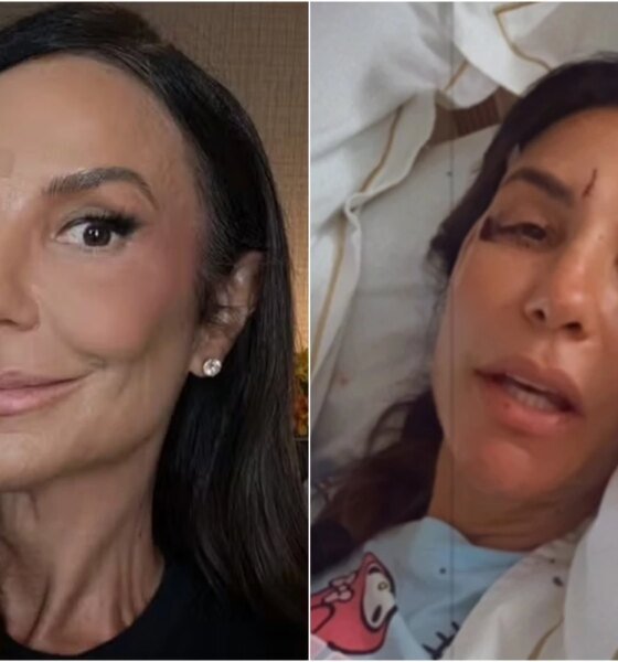 Ivete Sangalo mostra olho roxo dois dias depois de desmaio