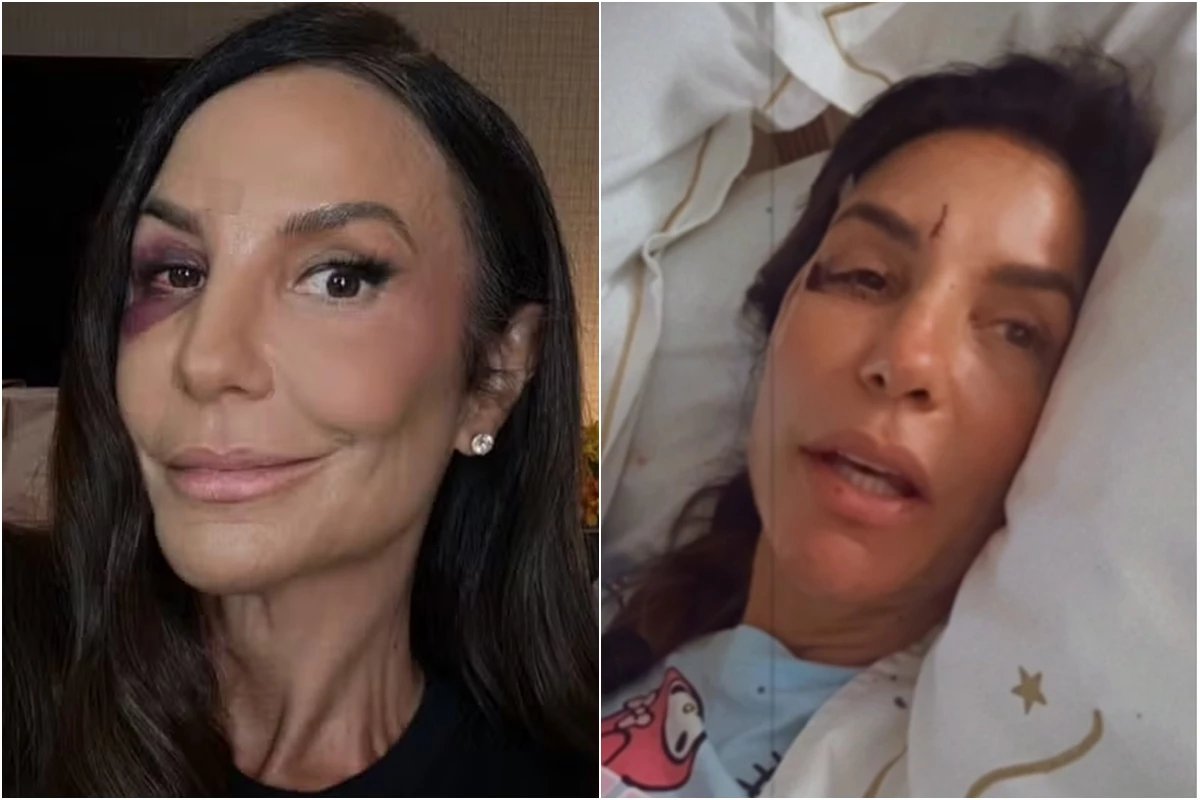 Ivete Sangalo mostra olho roxo dois dias depois de desmaio