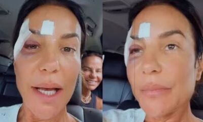 Ivete Sangalo surge com curativos no rosto apos receber alta